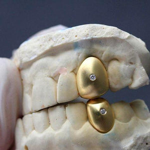 Single Gold Tooth with Diamond Toronto